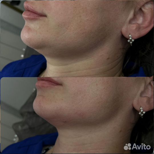 Игольчатый РФ лифтинг РФ лифтинг