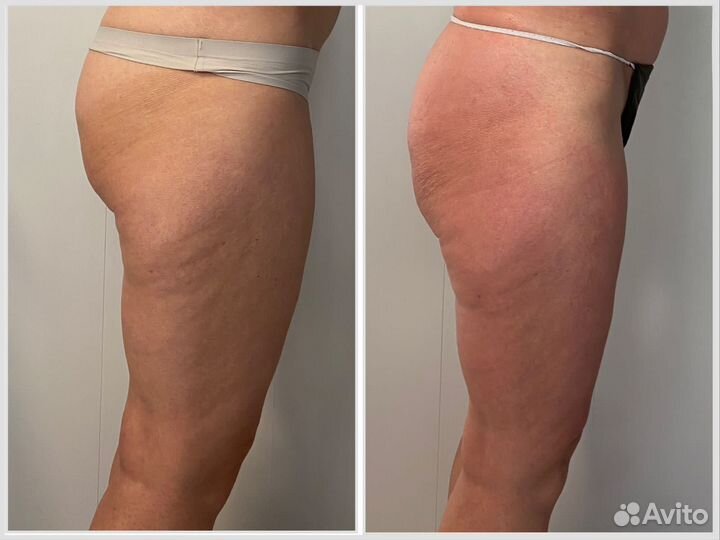 Антицеллюлитный массаж