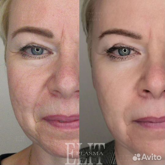 Омоложение холодной плазмой Ангарск