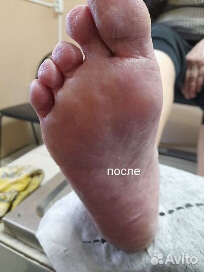 Педикюр любой сложности