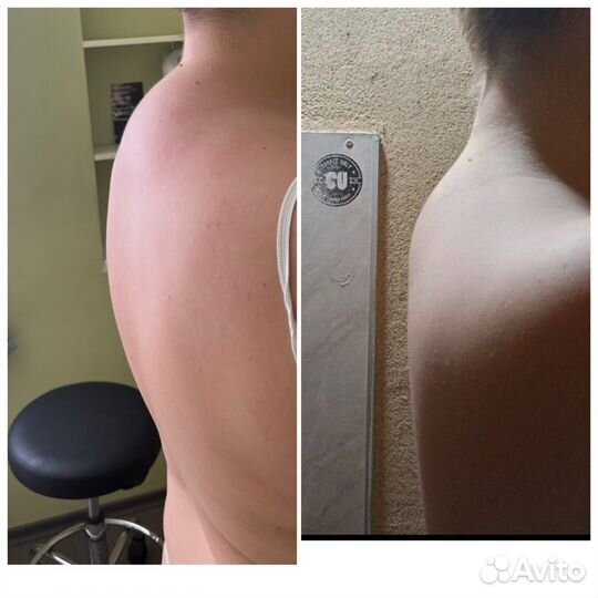 Армопластика Ручная липосакция Массаж