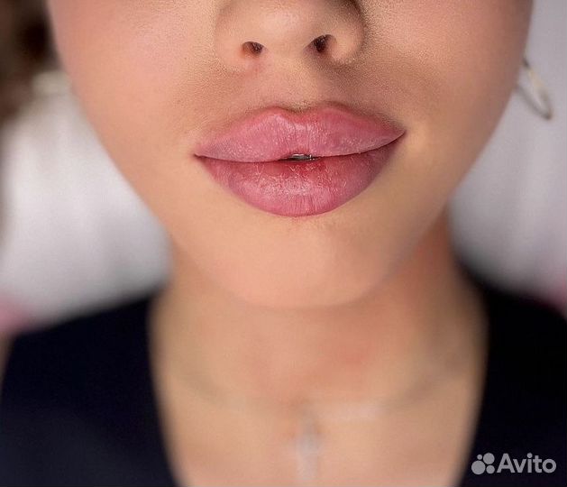 Увеличение губ