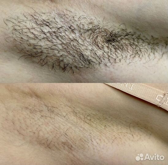 Обучение электроэпиляции