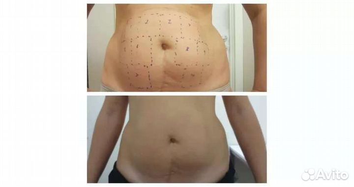 Липосоникс