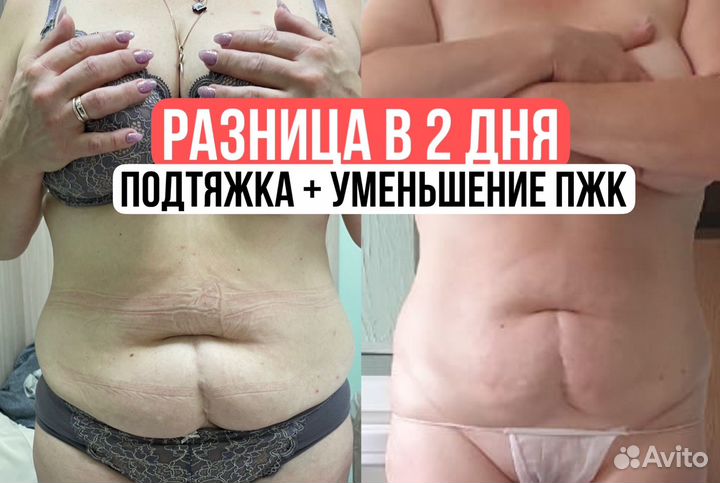 Похудение/липосоник/массаж