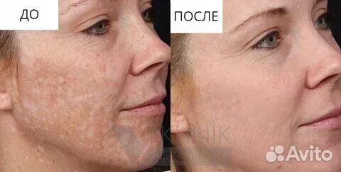 Пилинг SM PRX-33 /10 мл