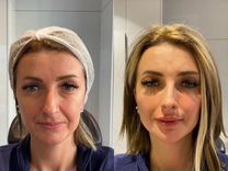 Модели на Подтяжку лица.Удаление морщин/Косметолог