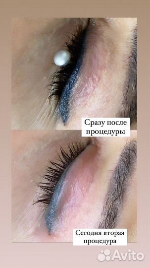 Удаление тату