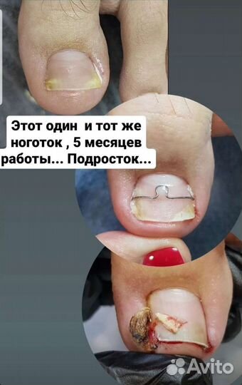 Педикюр подолог