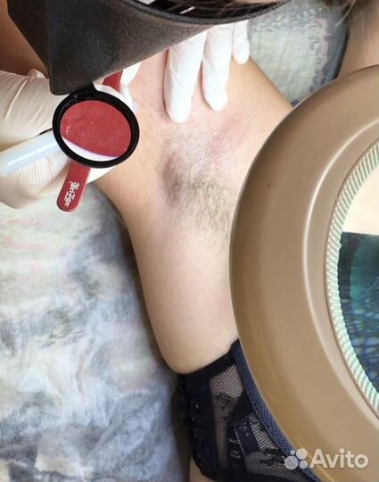 Обучение электроэпиляции /электроэпиляция