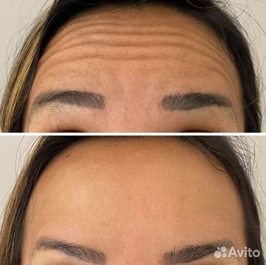 Ботокс лица