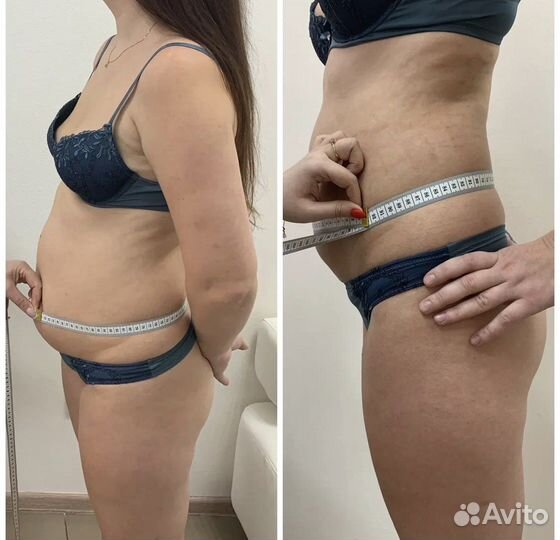 Липосакция аппаратная. Криолиполиз