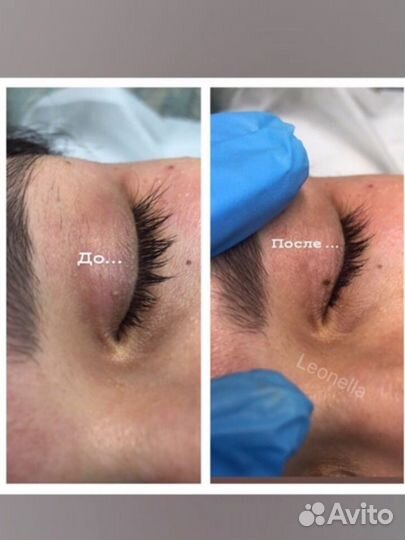 Лазер Папилломы Шрамы Растяжки