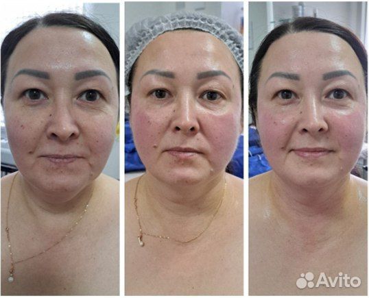 LPG массаж/вибро/вакуум/индиба