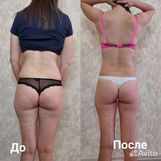 LPG массаж/ кавитация/ вибромассаж