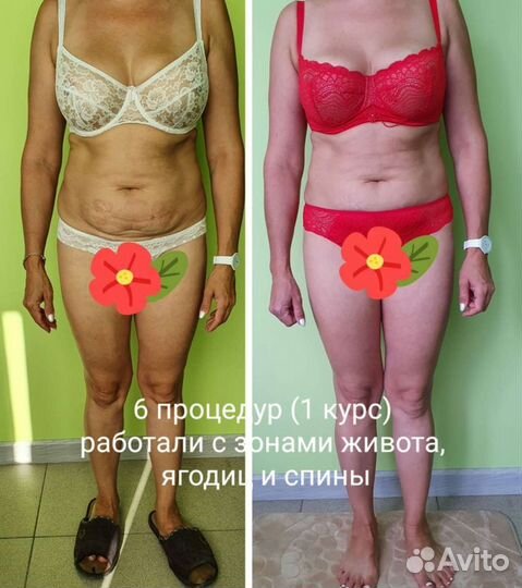 Коррекция фигуры на аппарате Slim beauty