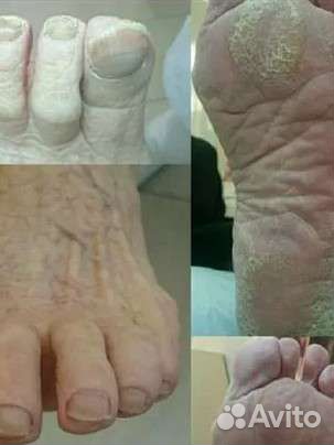 Медицинский педикюр. Подолог. Выезд на дом