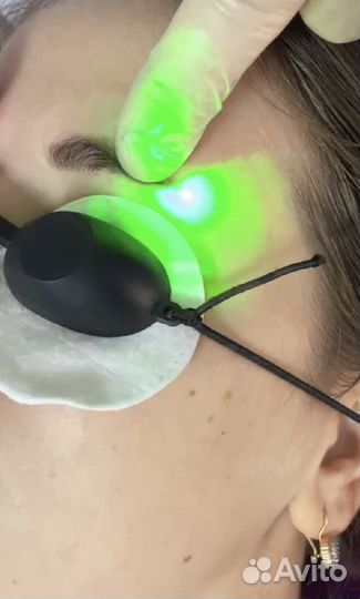 Удаление тату и татуажа. Карбоновый пилинг