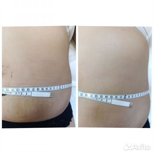 Аппаратное похудение