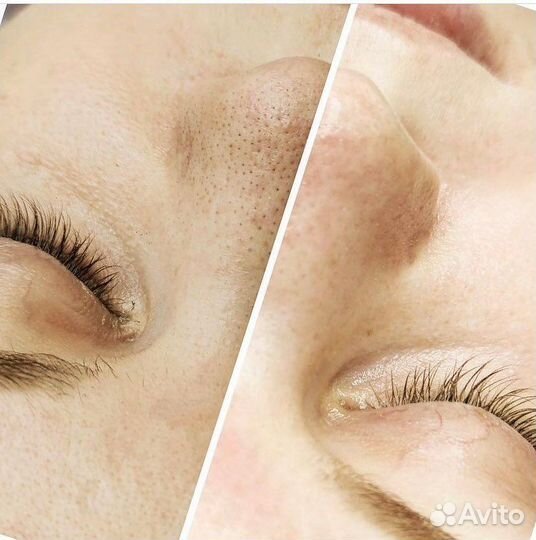 Комплексная Чистка Лица и Биоревитализация