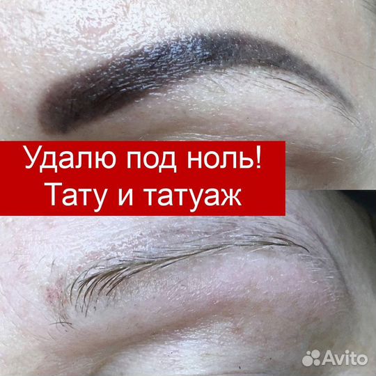 Удаление татуажа, тату, пилинг, лазерная эпиляция