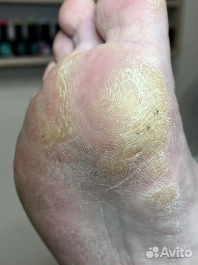 Педикюр, подология