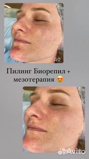 Карбокситерапия