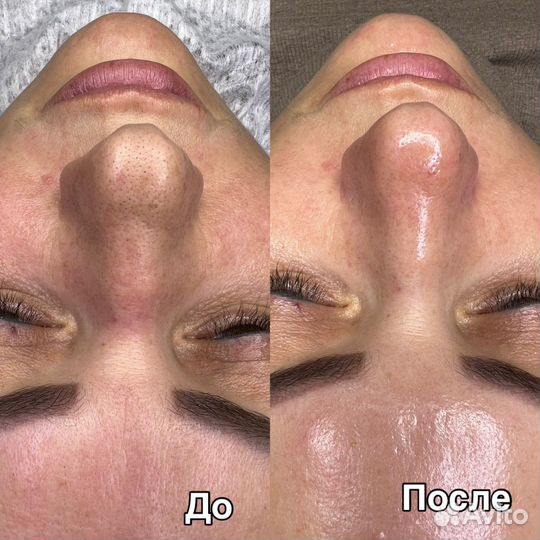 Косметолог/чистка лица/пилинг