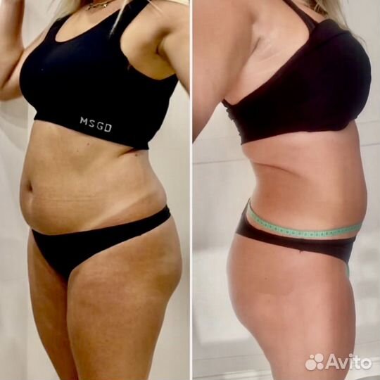 Криолиполиз липосакция без операции