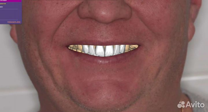 Удалённое моделирование в exocad