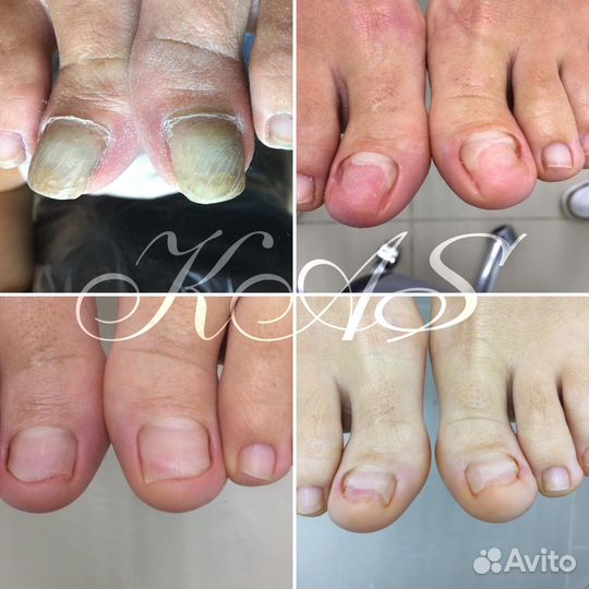 Вросший ноготь, медицинский педикюр, подолог