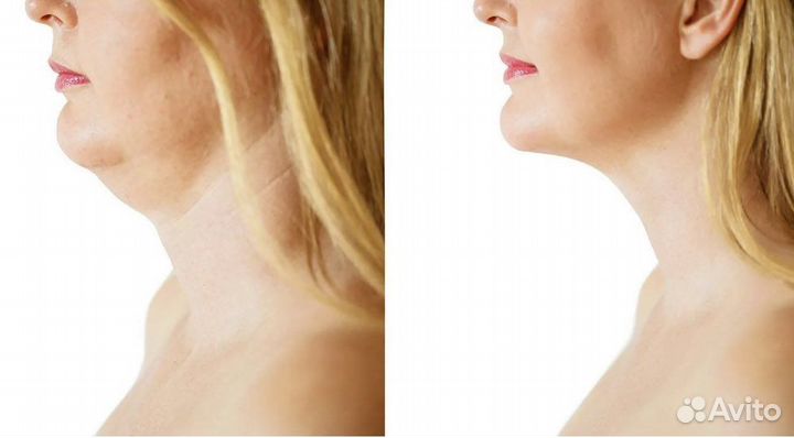 Липосакция аппаратная. Криолиполиз