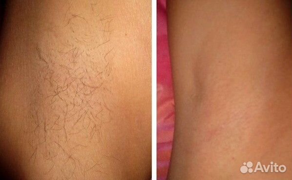 Шугаринг,педикюр,Выезд на дом