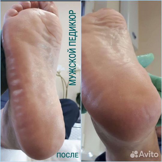 Педикюр любой сложности