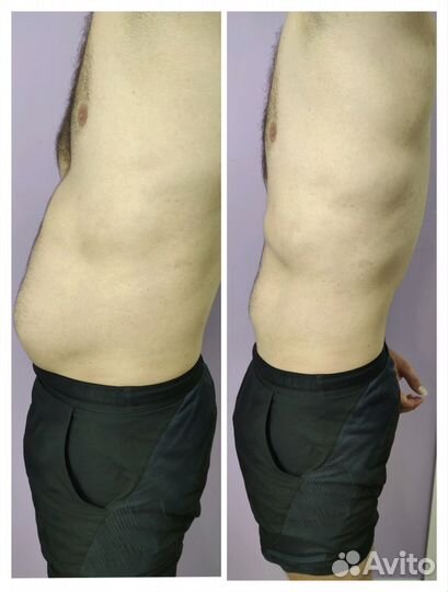 Криолиполиз