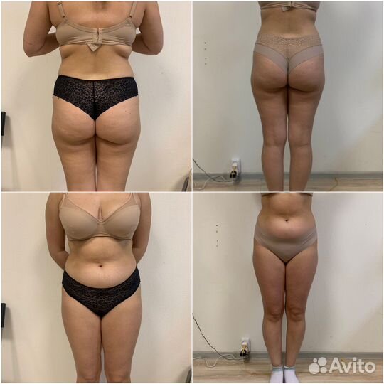 LPG,Антицеллюлитный,Кавитация,Эпиляция,массаж лиц