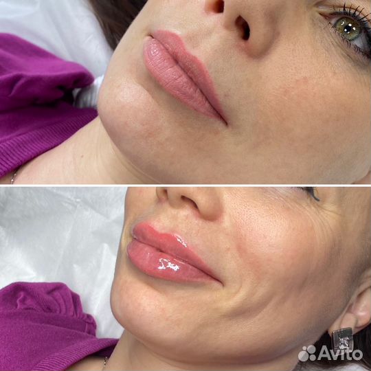 Инъекции, ботокс лица, губ, межбровье, лоб
