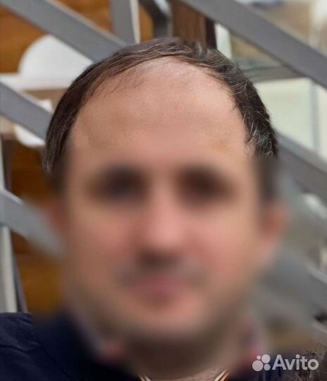 Пересадка волос без швов, рубцов и шрамов