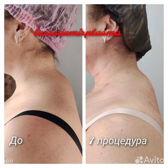 Холодная плазма