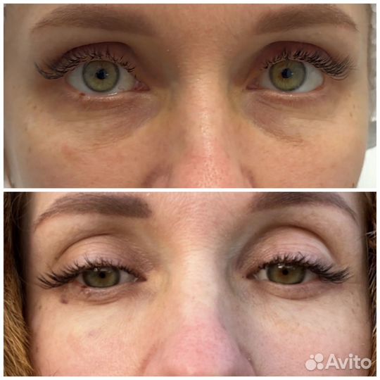 Биоверитализация глаз (зона орбитты )