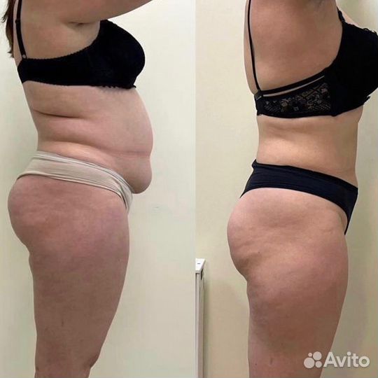 Липолитики, худое лицо, стройное тело, жиротоп