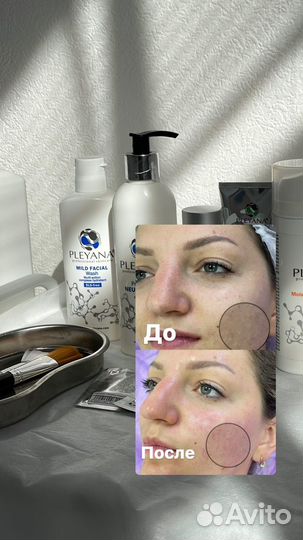 Чистка лица