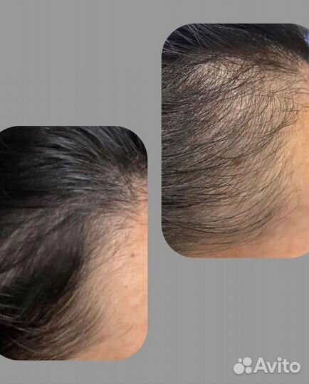Лечение волос /мезотератия волос
