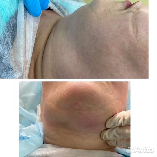 Липоредукция