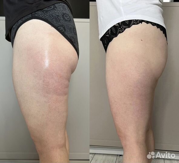 Аппаратный массаж