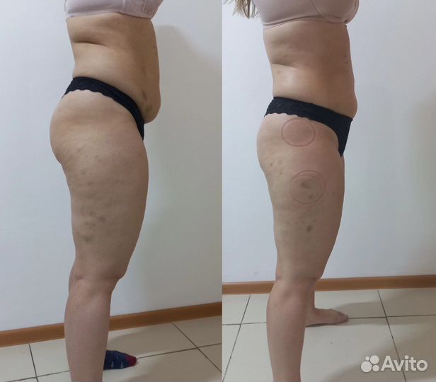 Антицеллюлитный массаж