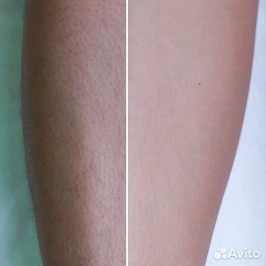 Шугаринг: глубокое бикини