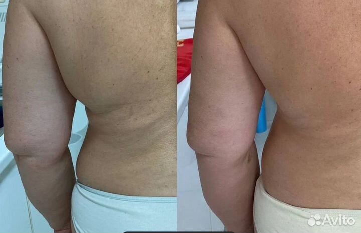 Липосакция без операции