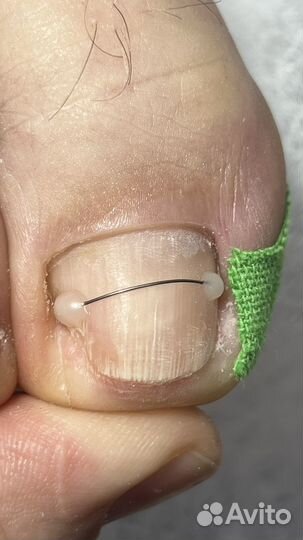 Педикюр медицинский подолог