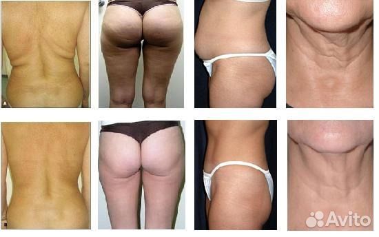 Аппаратный массаж